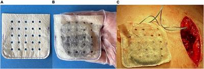 Physician antibiotic hydration preferences for biologic antibacterial envelopes during cardiac implantable device procedures